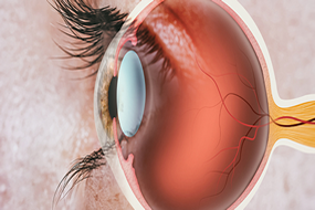 Corneal Services