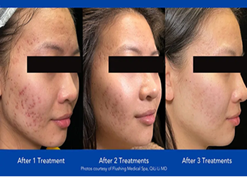 AviClear Acne Laser
